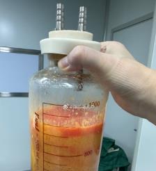 汕尾水动力吸脂手术要做多久？